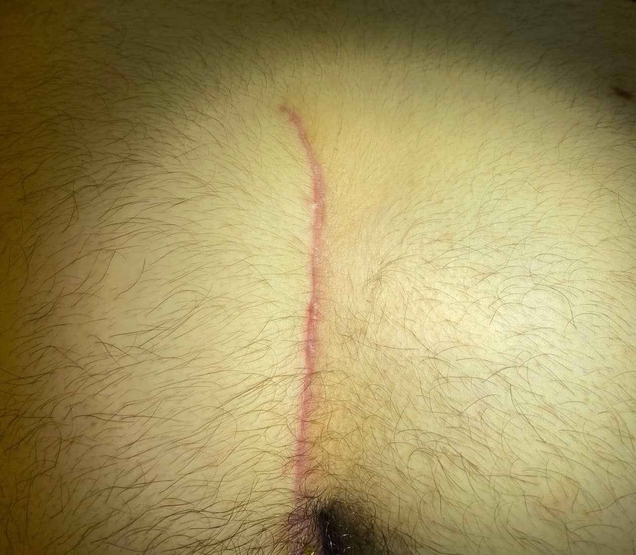 Pilonidal Scar