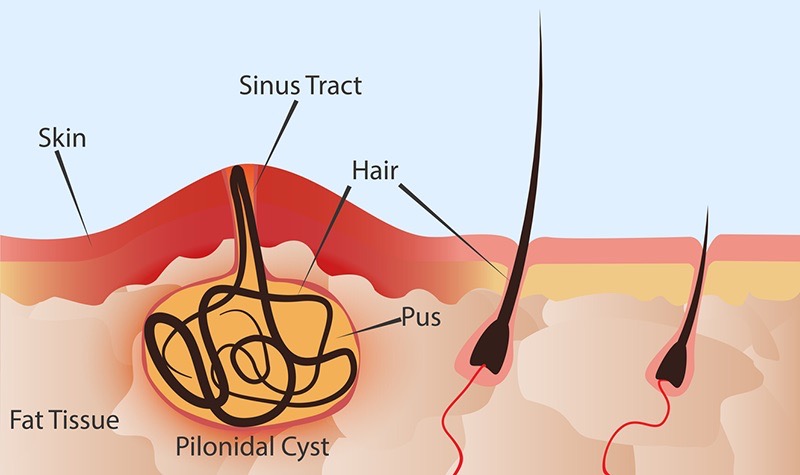 pilondial cyst infographic